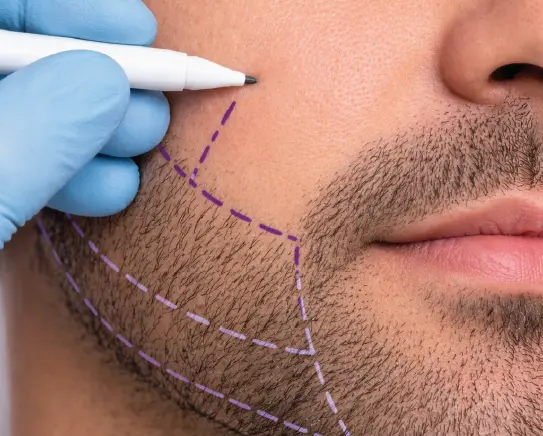 Doctor marking beard transplant area on male face for facial hair restoration