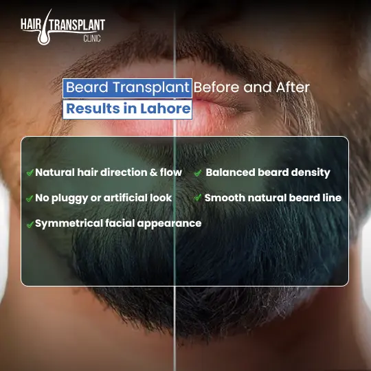 Beard transplant before and after results in Lahore showing natural density and beard line