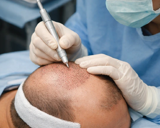 DHI hair transplant surgeon implanting hair grafts using choi pen on bald scalp
