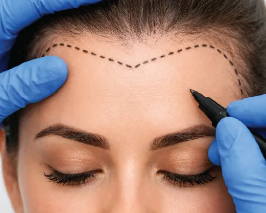 Doctor marking female hairline design for women hair transplant surgery