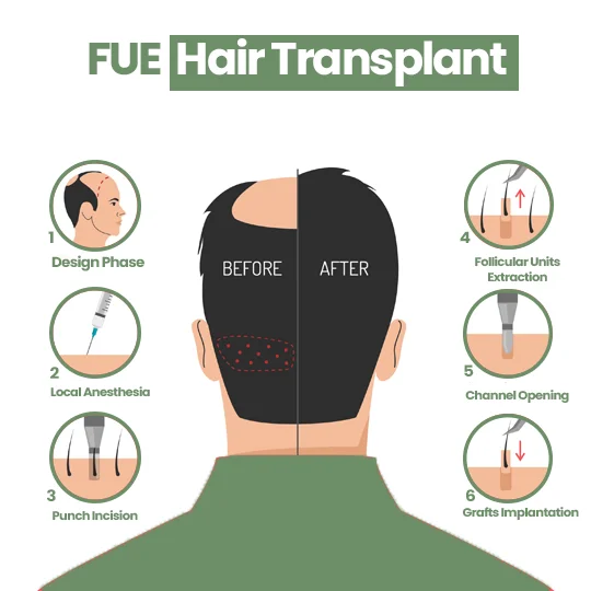 FUE hair transplant steps showing design phase, anesthesia, punch incision and graft implantation