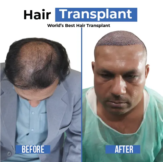 Hair transplant before and after for male pattern baldness with visible graft coverage