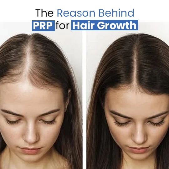 The reason behind PRP for hair growth showing before and after results of women with thinning hair
