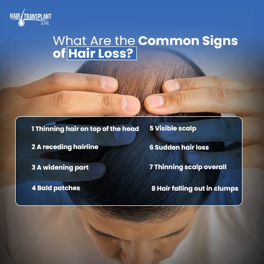 Common signs of hair loss including thinning hair, receding hairline, bald patches and hair shedding