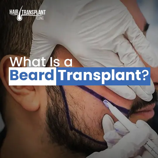 What is a beard transplant showing facial hair follicle marking and implantation procedure