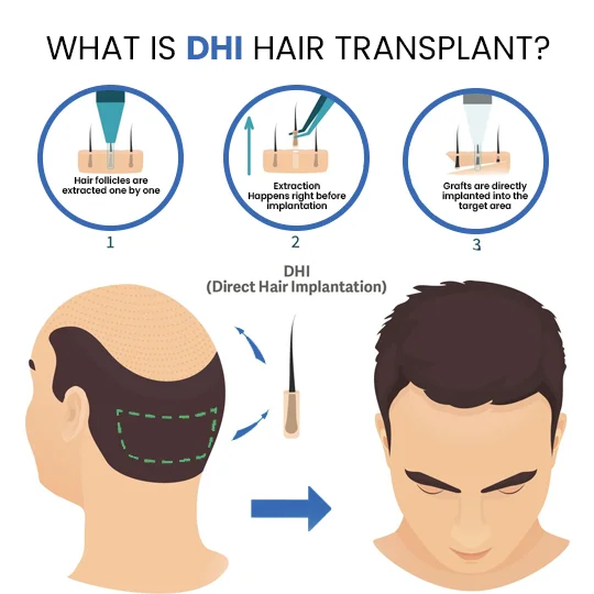 What is DHI hair transplant showing follicle extraction, implantation steps and before after results